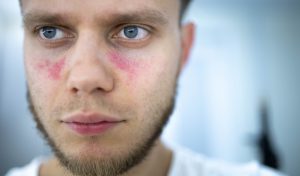 Mitos y realidades sobre el lupus, enfermedad autoinmunitaria